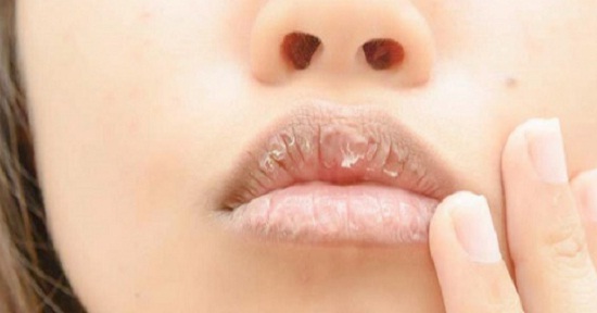 Bibir kering (ilustrasi)