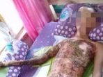 Warga Kadupandak Disambar Listrik Tegangan Tinggi, Seluruh Tubuhnya Melepuh