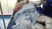 Si Melon Meledak, Satu Keluarga Alami Luka Bakar
