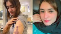 Riri Aprilia Kartin (kanan, foto instagram) menunjukkan luka lebam akibat dianiaya Polwan Brigadir IR