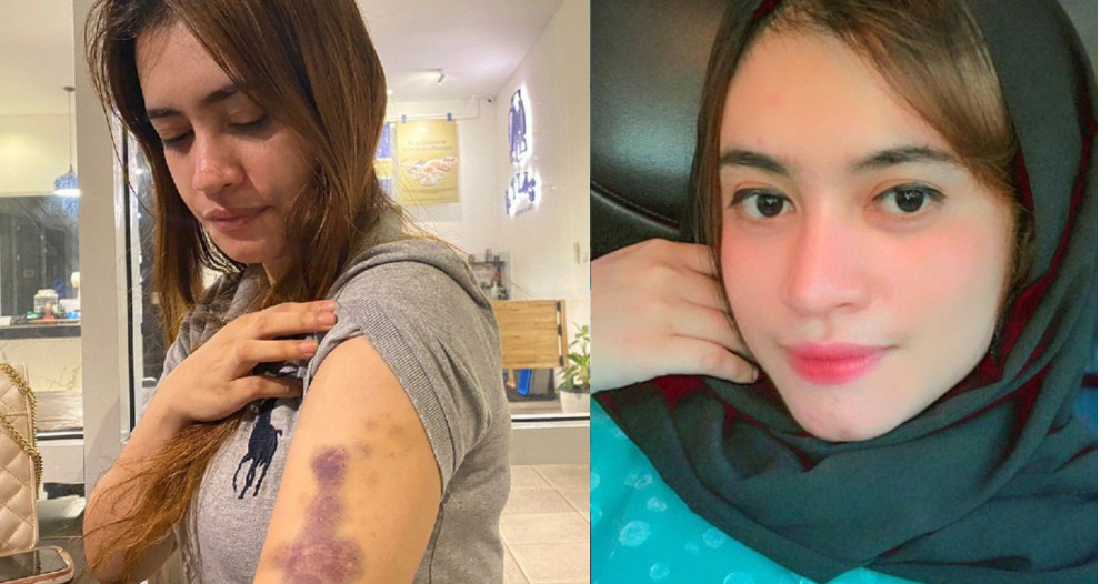 Riri Aprilia Kartin (kanan, foto instagram) menunjukkan luka lebam akibat dianiaya Polwan Brigadir IR
