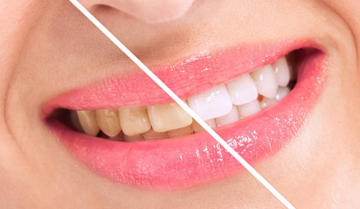 Cara memutihkan Gigi secara alami.