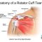 Ilustrasi robekan pada tendon dari otot bahu