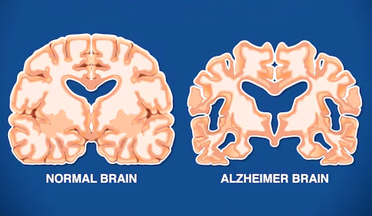 Dokter Spesialis Neurologi mengungkapkan bahwa gadget tingkatkan resiko disfungsi otak salah satunya alzheimer bagi genarasi muda.-freepik-