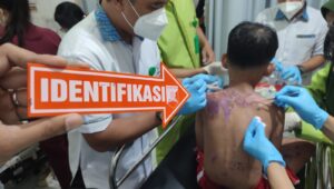 Potret Ibu dan Anak di Baros Kota Sukabumi Disiram Air keras